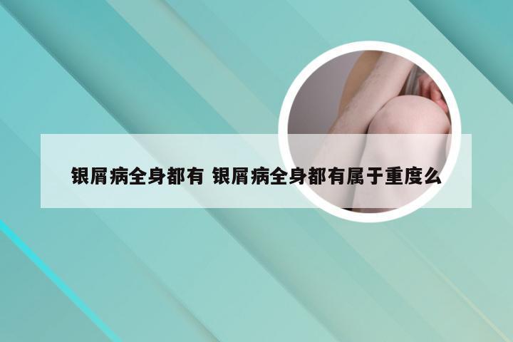 银屑病全身都有 银屑病全身都有属于重度么