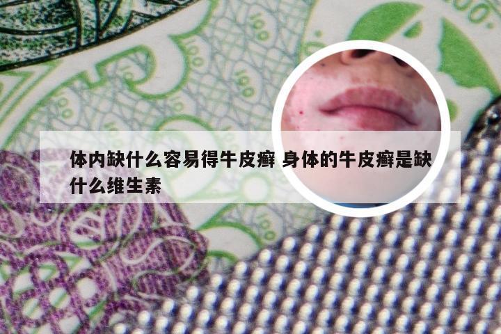 体内缺什么容易得牛皮癣 身体的牛皮癣是缺什么维生素