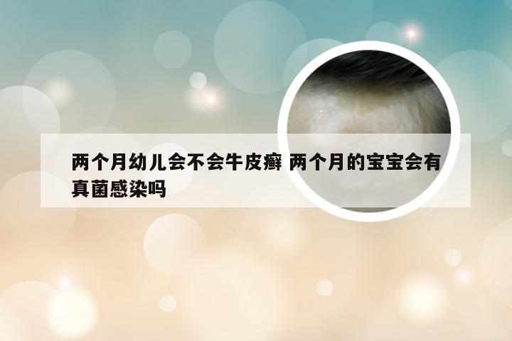 两个月幼儿会不会牛皮癣 两个月的宝宝会有真菌感染吗
