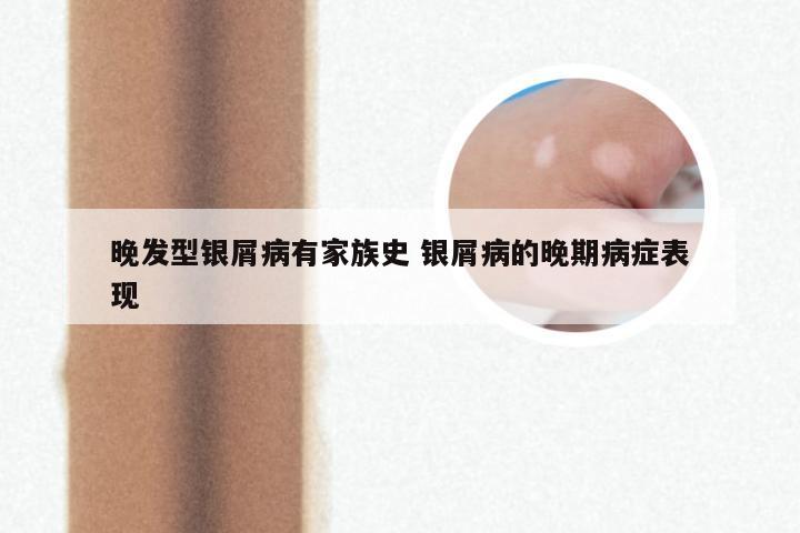 晚发型银屑病有家族史 银屑病的晚期病症表现