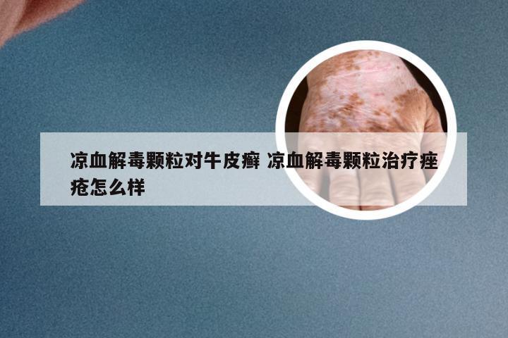 凉血解毒颗粒对牛皮癣 凉血解毒颗粒治疗痤疮怎么样
