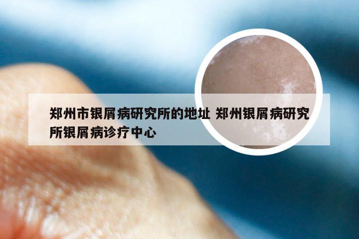 郑州市银屑病研究所的地址 郑州银屑病研究所银屑病诊疗中心