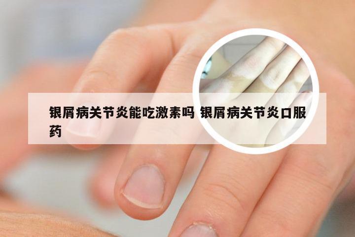 银屑病关节炎能吃激素吗 银屑病关节炎口服药