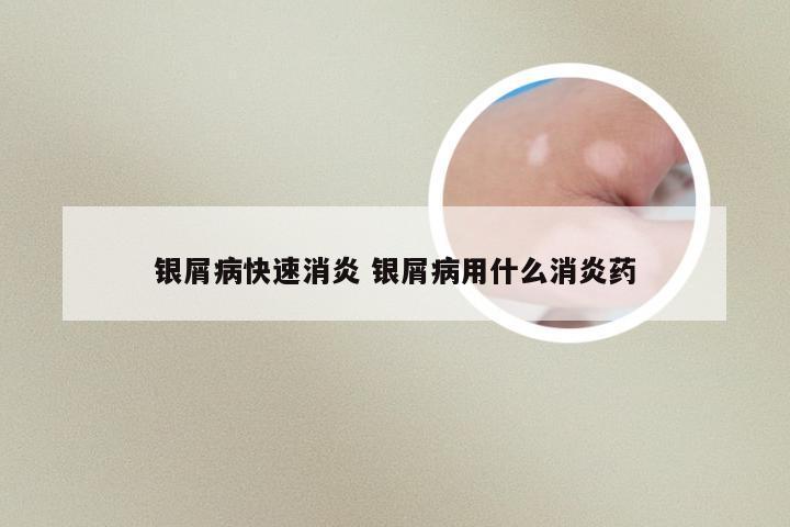 银屑病快速消炎 银屑病用什么消炎药