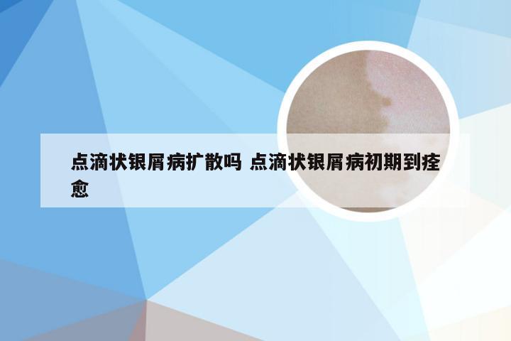 点滴状银屑病扩散吗 点滴状银屑病初期到痊愈