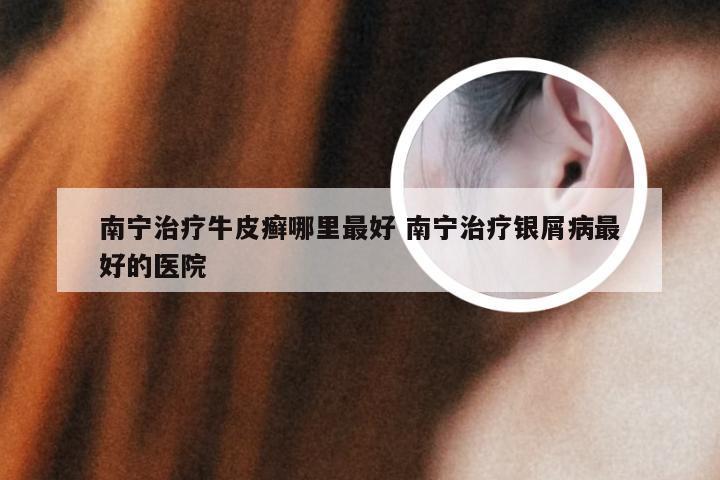 南宁治疗牛皮癣哪里最好 南宁治疗银屑病最好的医院