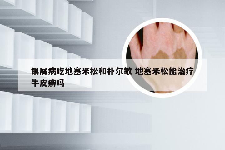 银屑病吃地塞米松和扑尔敏 地塞米松能治疗牛皮癣吗