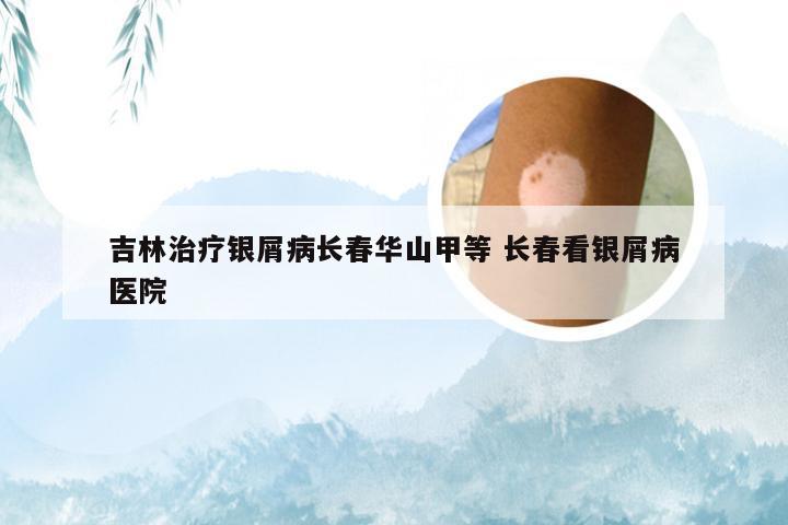 吉林治疗银屑病长春华山甲等 长春看银屑病医院