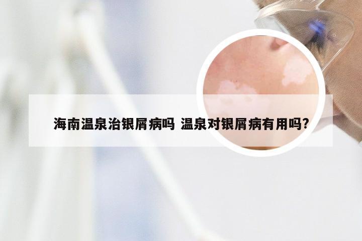 海南温泉治银屑病吗 温泉对银屑病有用吗?