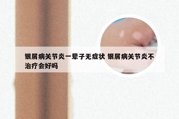 银屑病关节炎一辈子无症状 银屑病关节炎不治疗会好吗