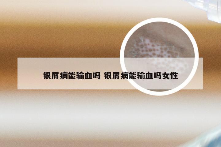 银屑病能输血吗 银屑病能输血吗女性