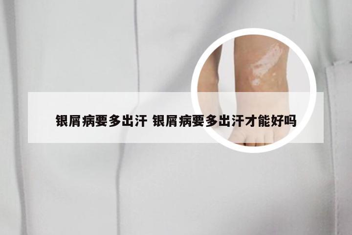 银屑病要多出汗 银屑病要多出汗才能好吗