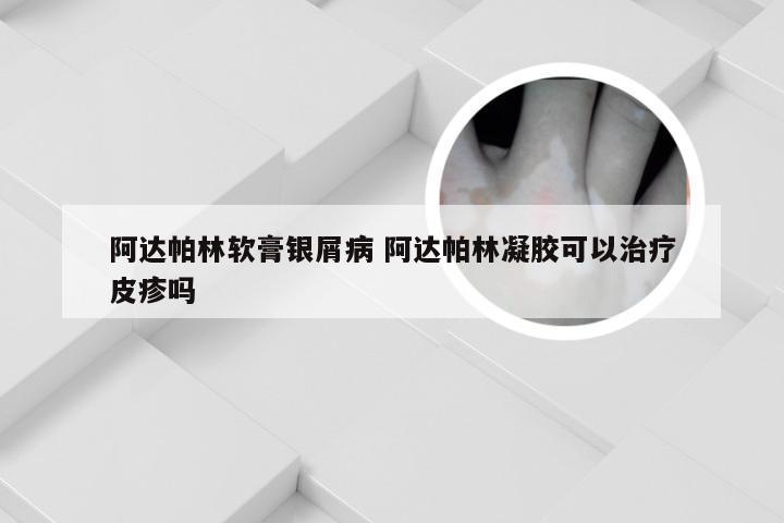 阿达帕林软膏银屑病 阿达帕林凝胶可以治疗皮疹吗