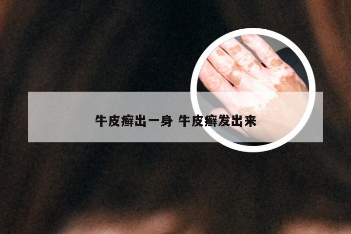 牛皮癣出一身 牛皮癣发出来