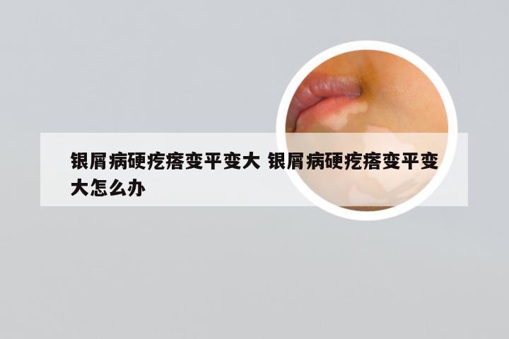 银屑病硬疙瘩变平变大 银屑病硬疙瘩变平变大怎么办