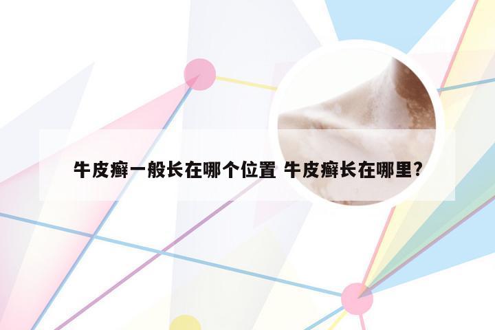 牛皮癣一般长在哪个位置 牛皮癣长在哪里?