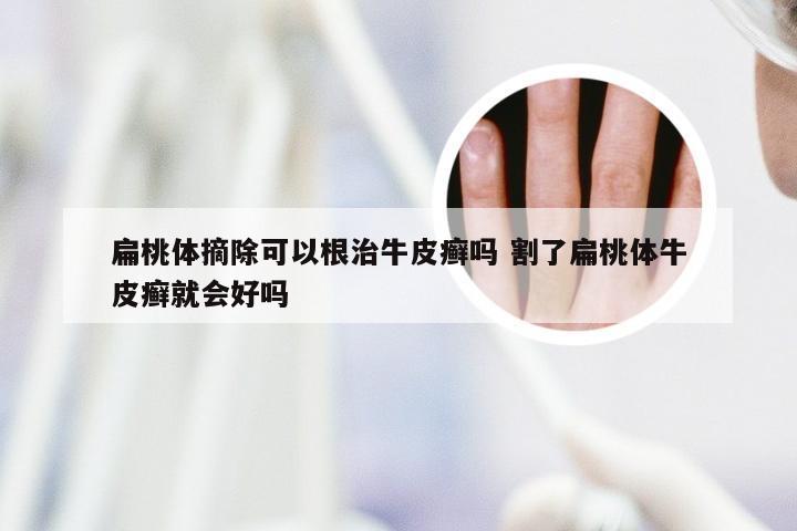 扁桃体摘除可以根治牛皮癣吗 割了扁桃体牛皮癣就会好吗