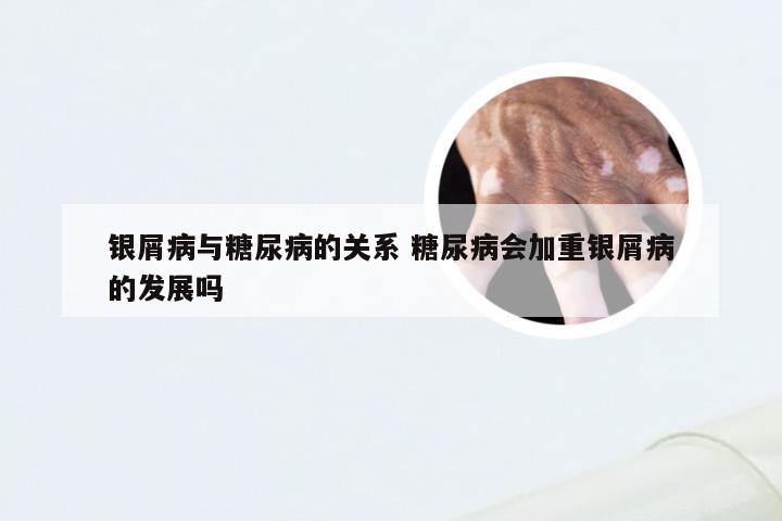 银屑病与糖尿病的关系 糖尿病会加重银屑病的发展吗