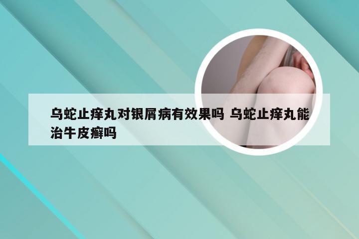 乌蛇止痒丸对银屑病有效果吗 乌蛇止痒丸能治牛皮癣吗