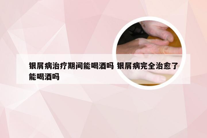 银屑病治疗期间能喝酒吗 银屑病完全治愈了能喝酒吗