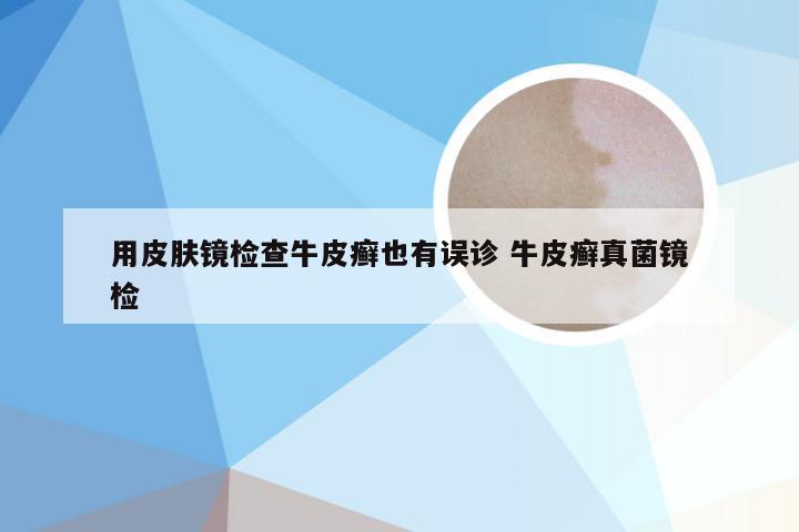 用皮肤镜检查牛皮癣也有误诊 牛皮癣真菌镜检