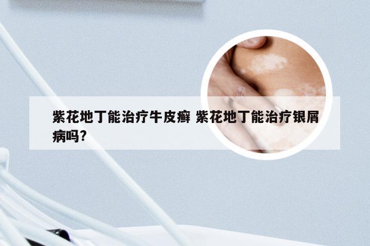 紫花地丁能治疗牛皮癣 紫花地丁能治疗银屑病吗?
