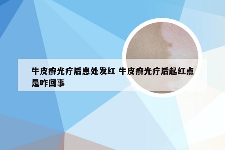 牛皮癣光疗后患处发红 牛皮癣光疗后起红点是咋回事