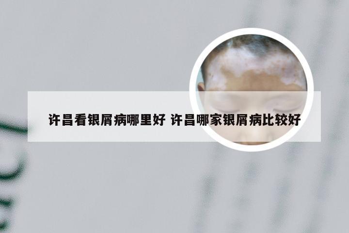 许昌看银屑病哪里好 许昌哪家银屑病比较好
