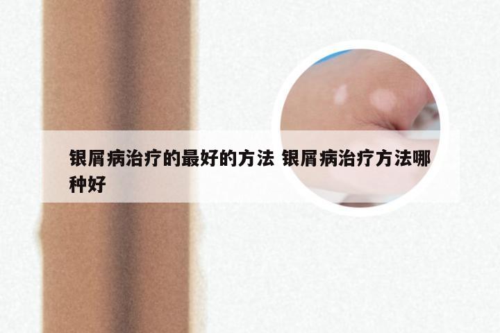 银屑病治疗的最好的方法 银屑病治疗方法哪种好