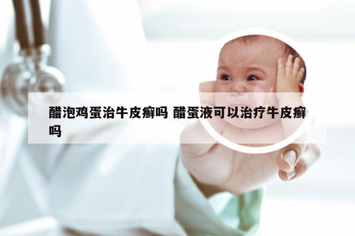 醋泡鸡蛋治牛皮癣吗 醋蛋液可以治疗牛皮癣吗