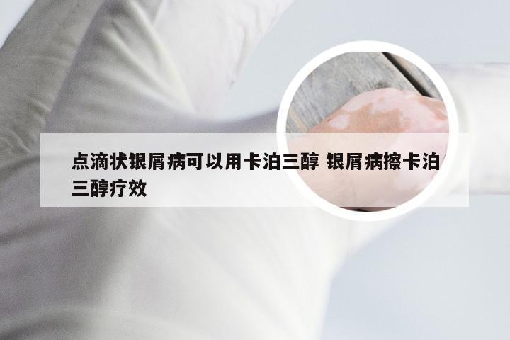 点滴状银屑病可以用卡泊三醇 银屑病擦卡泊三醇疗效