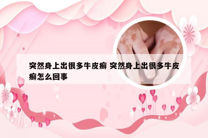 突然身上出很多牛皮癣 突然身上出很多牛皮癣怎么回事