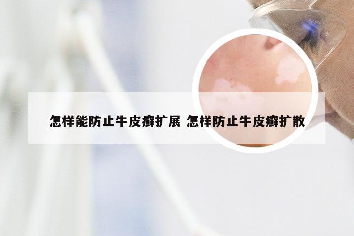 怎样能防止牛皮癣扩展 怎样防止牛皮癣扩散