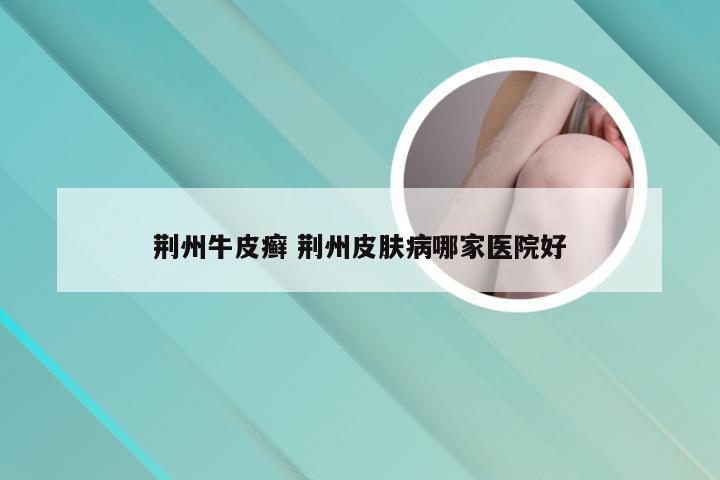 荆州牛皮癣 荆州皮肤病哪家医院好