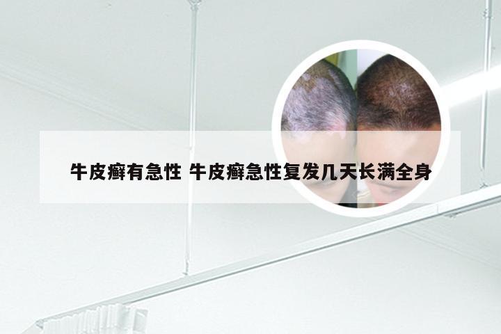 牛皮癣有急性 牛皮癣急性复发几天长满全身