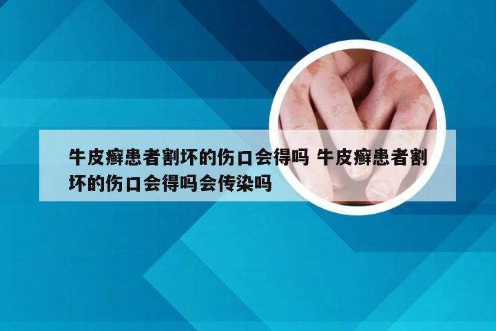 牛皮癣患者割坏的伤口会得吗 牛皮癣患者割坏的伤口会得吗会传染吗