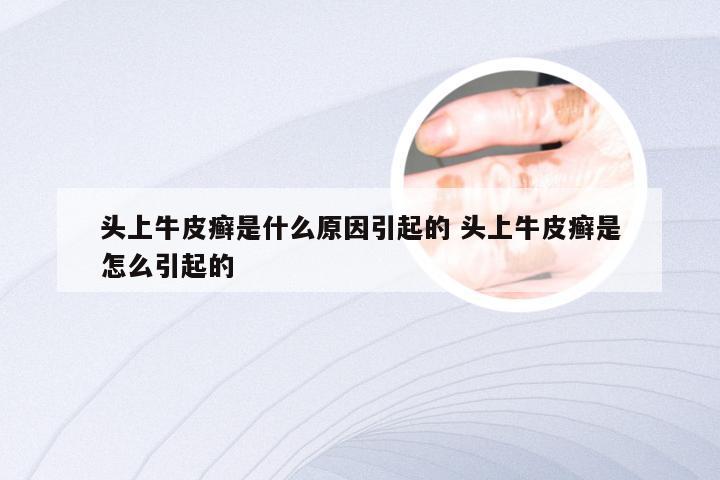 头上牛皮癣是什么原因引起的 头上牛皮癣是怎么引起的