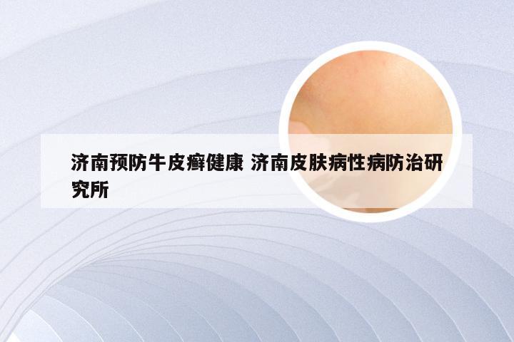 济南预防牛皮癣健康 济南皮肤病性病防治研究所