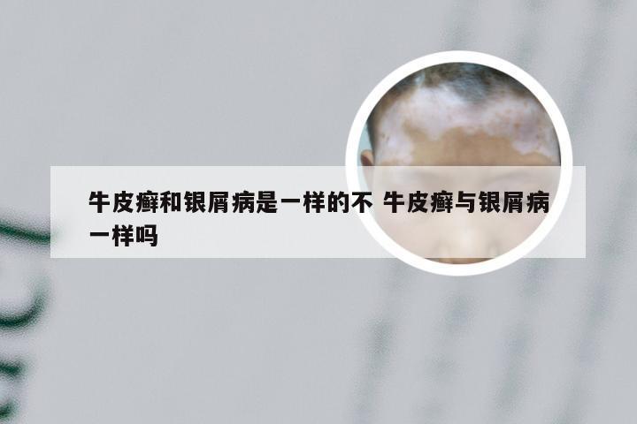 牛皮癣和银屑病是一样的不 牛皮癣与银屑病一样吗