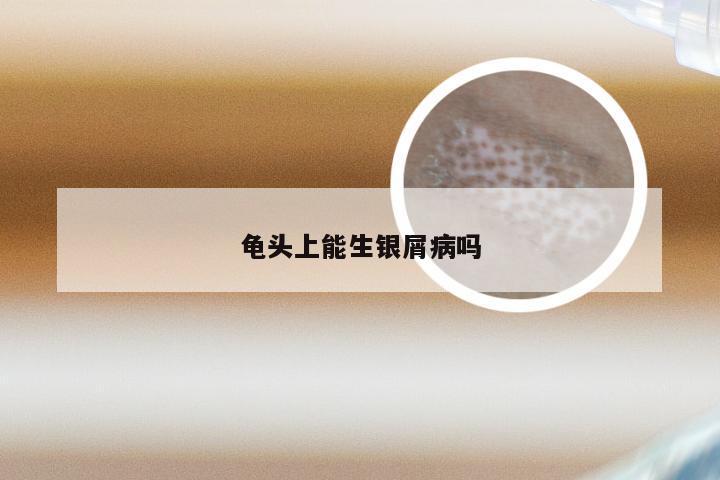 龟头上能生银屑病吗