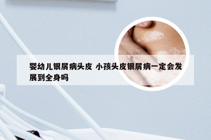 婴幼儿银屑病头皮 小孩头皮银屑病一定会发展到全身吗