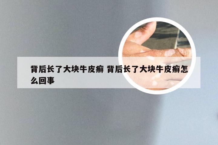 背后长了大块牛皮癣 背后长了大块牛皮癣怎么回事