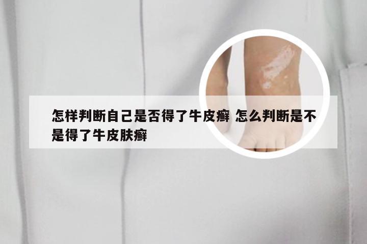 怎样判断自己是否得了牛皮癣 怎么判断是不是得了牛皮肤癣