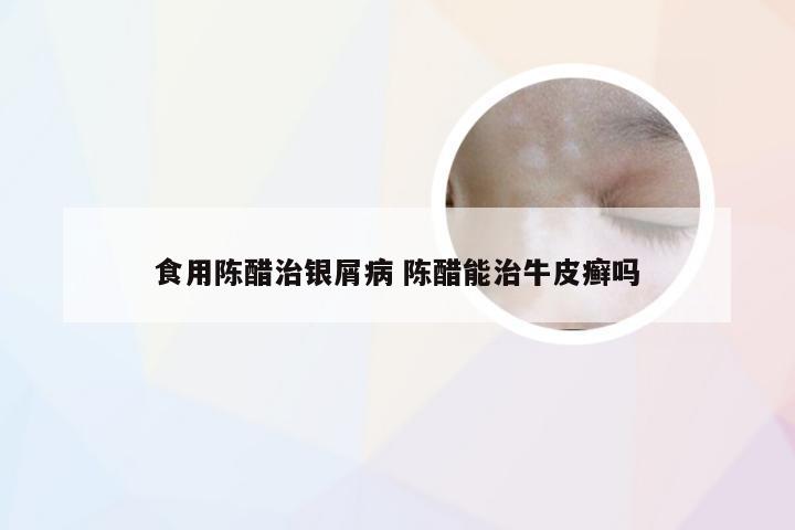 食用陈醋治银屑病 陈醋能治牛皮癣吗