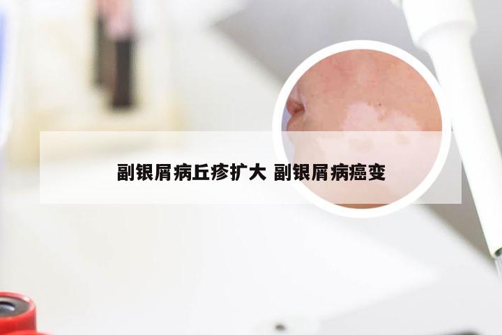 副银屑病丘疹扩大 副银屑病癌变
