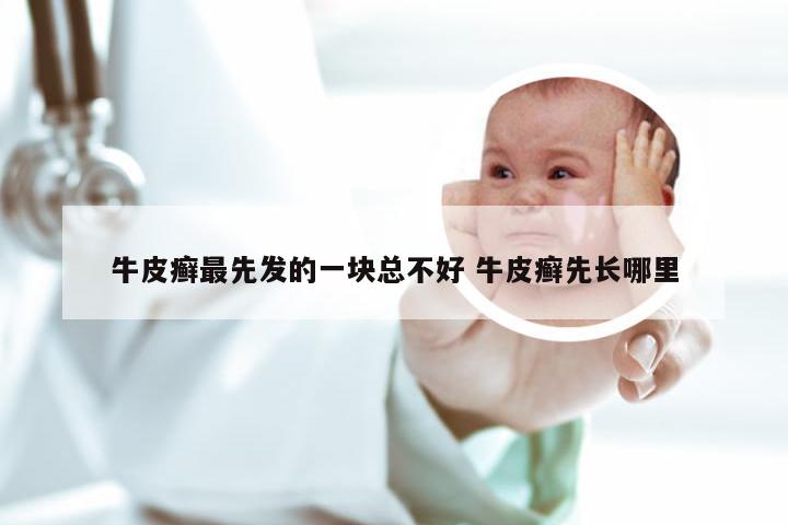 牛皮癣最先发的一块总不好 牛皮癣先长哪里