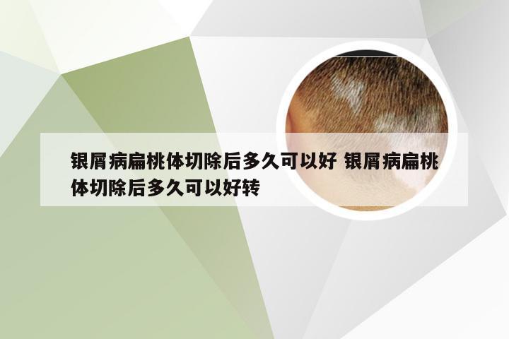 银屑病扁桃体切除后多久可以好 银屑病扁桃体切除后多久可以好转