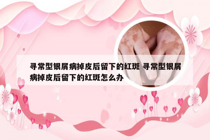 寻常型银屑病掉皮后留下的红斑 寻常型银屑病掉皮后留下的红斑怎么办