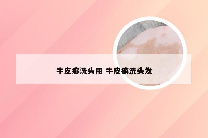 牛皮癣洗头用 牛皮癣洗头发