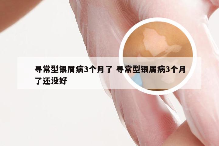 寻常型银屑病3个月了 寻常型银屑病3个月了还没好